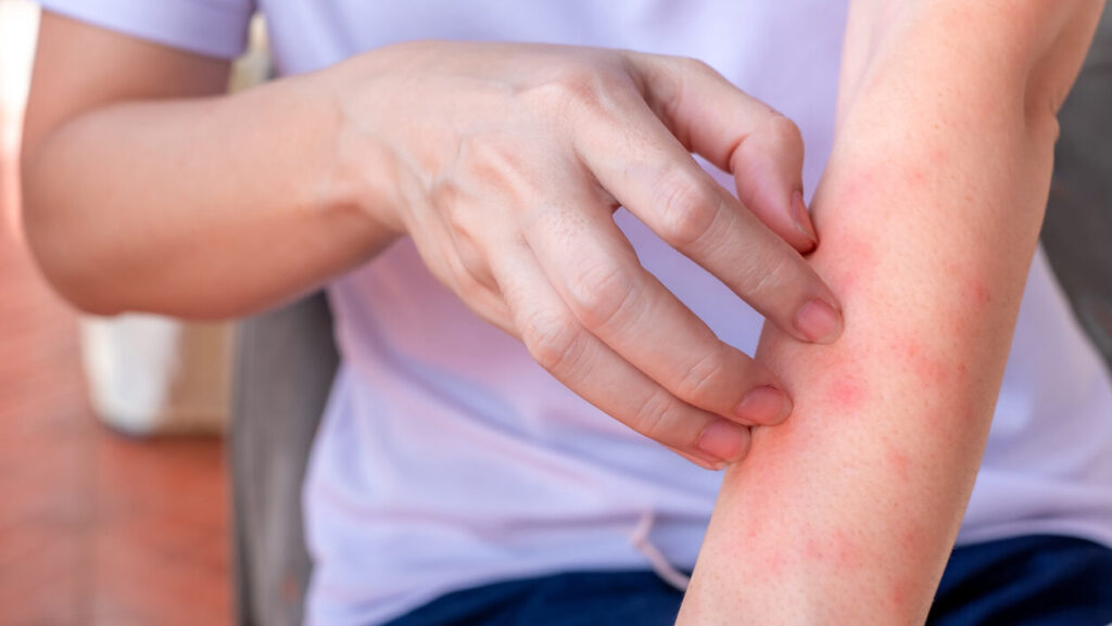 Rash | Chesapeake Telemedicine